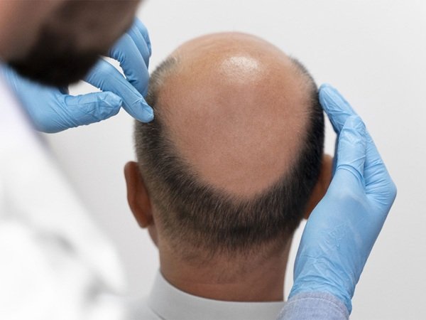 Which is the Best Hair Transplant Clinic in Hyderabad? What You Should Know Before Choosing a Clinic?